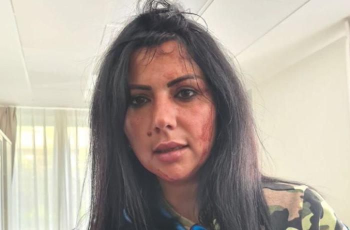 Belçikadakı aksiyada yaralanan jurnalist erməni vəhşiliyindən DANIŞDI
