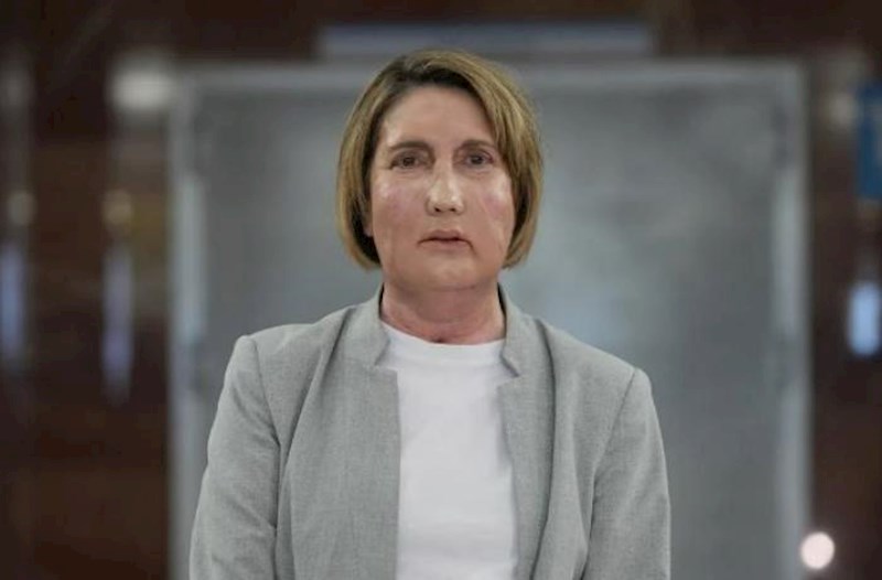 İspaniyada həkimlər evtanaziya ilə ölən qadının üzünü köçürdülər