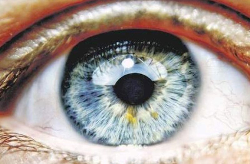 İrsi korluğun müalicəsi ilk uğurlu gen terapiyası kimi tarixə düşüb